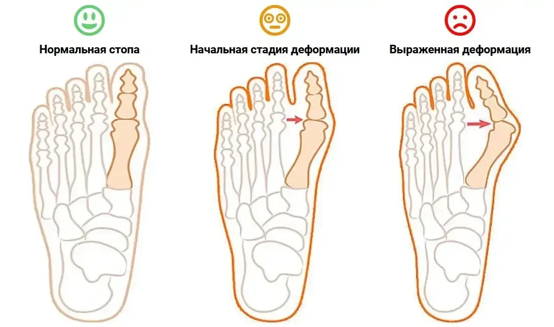 Магнітна вальгусна шина RELAX FOOT (Magnet Fix) Магнітний коректор стопи - Image 7