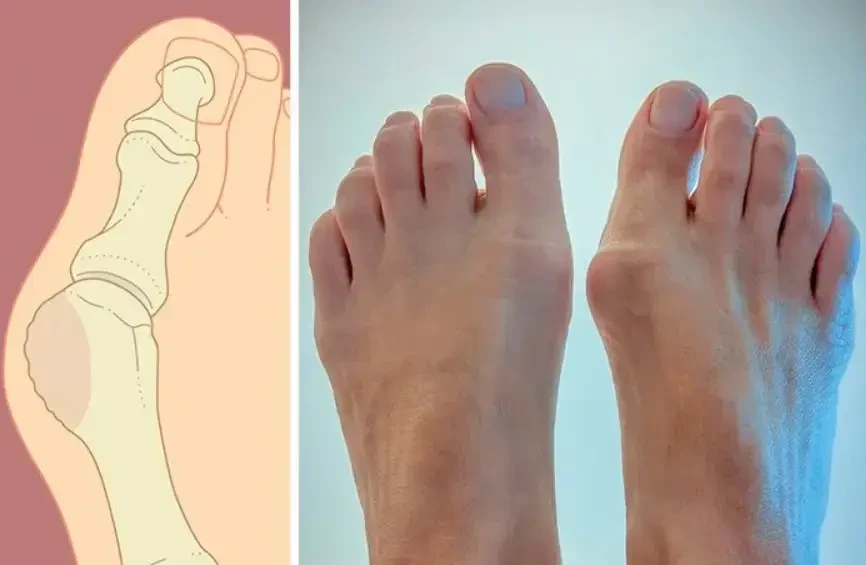 Магнітна вальгусна шина RELAX FOOT (Magnet Fix) Магнітний коректор стопи - Image 8
